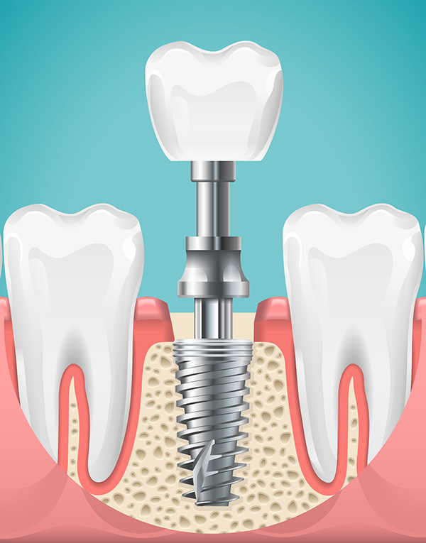 Zahnarztpraxis-dr.-frei-dr.-gruner-implantologie-bad-toelz